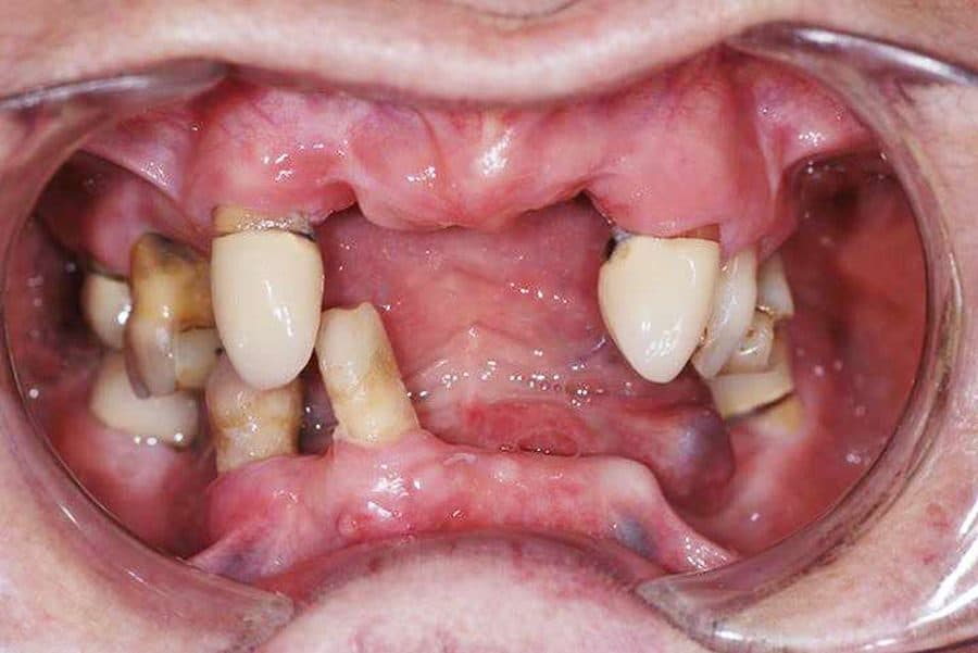 Before: a failing upper arch ahead of implant-retained bridgework made at the Poole lab