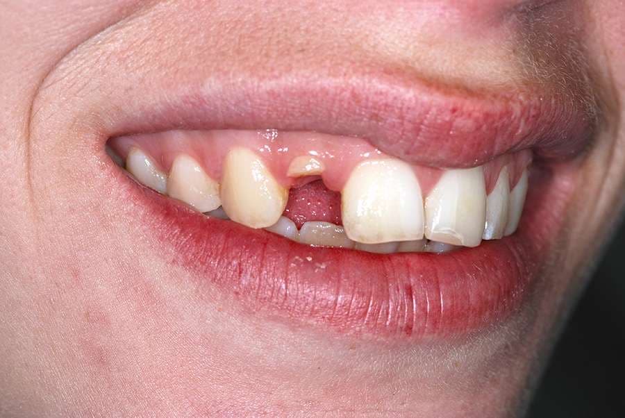 Before: a single missing tooth ahead of an implant crown made at the Poole lab