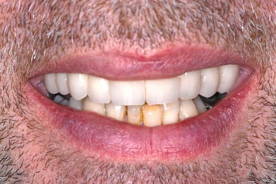 Implant Crowns, Made in Our Poole Lab