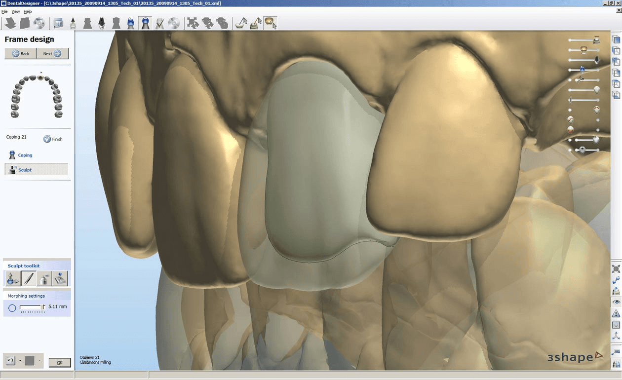 An implant crown being designed digitally at the Wessex lab in Poole