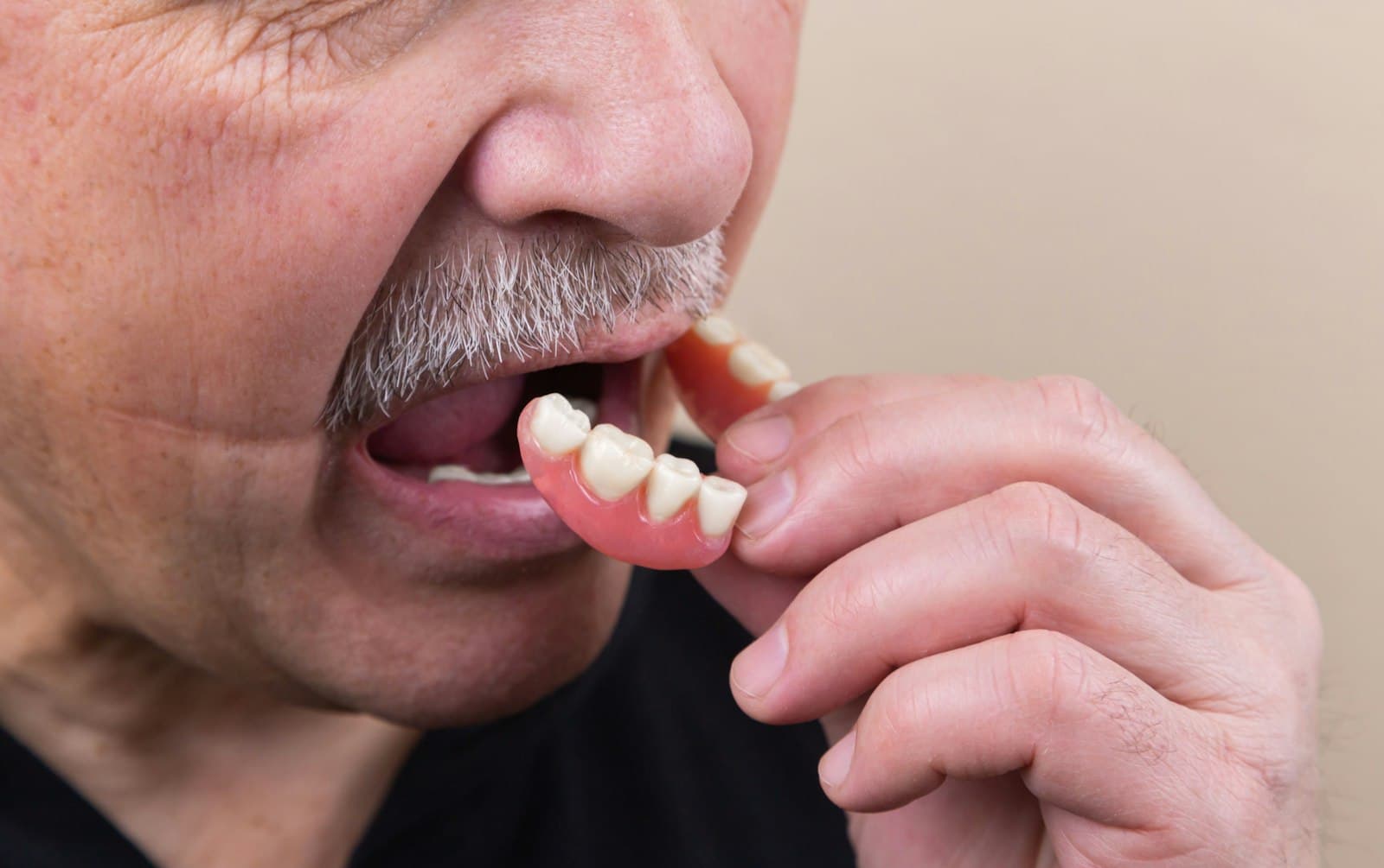 Acrylic Dentures