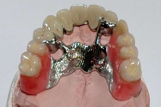 Partial Dentures in Poole & Bournemouth