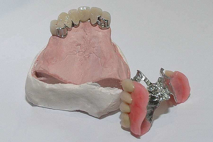 Chrome Dentures