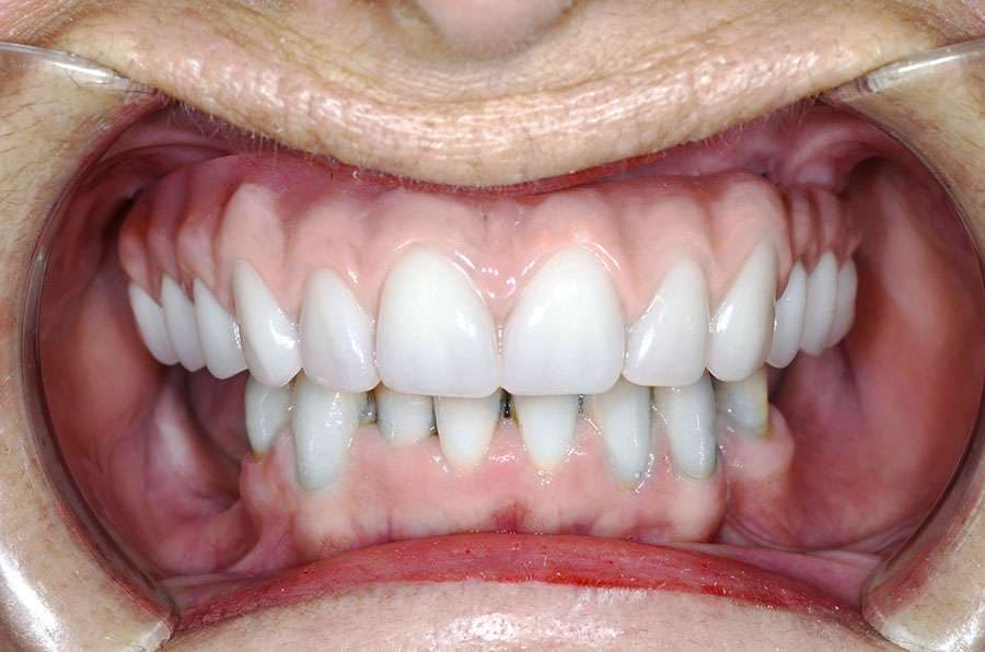 Implant Crowns at the Wessex dental laboratory