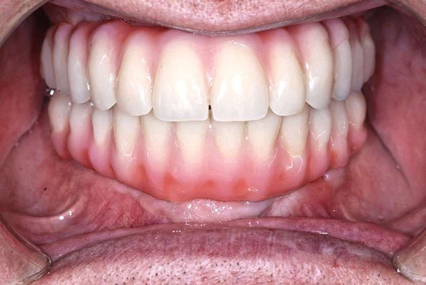Implant-Retained Dentures